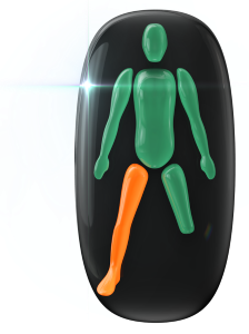 片方の下肢の動きに中等度の障害、もう片方の下肢の膝から下が欠損。